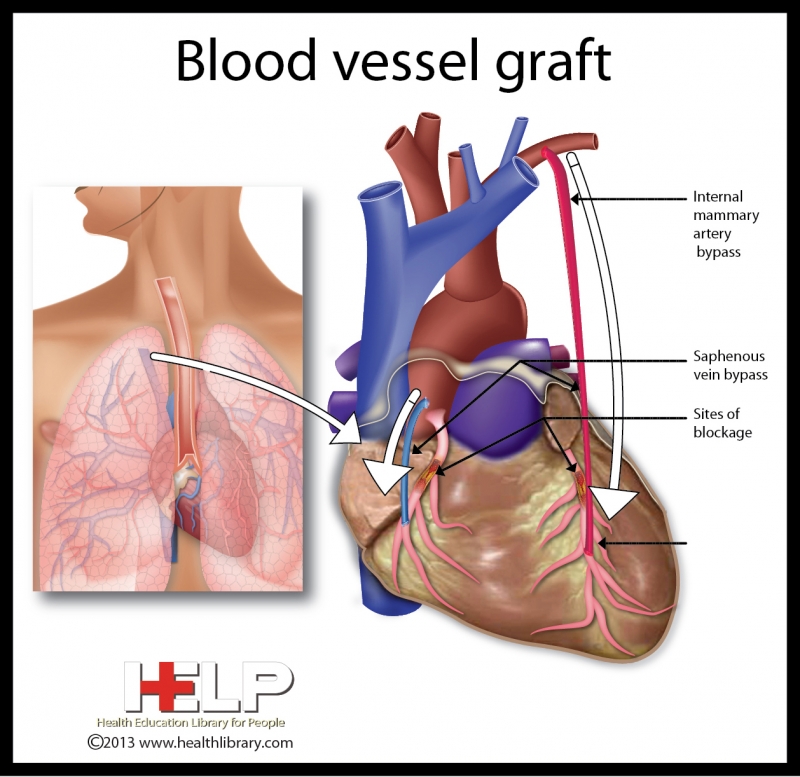 Blood Graft